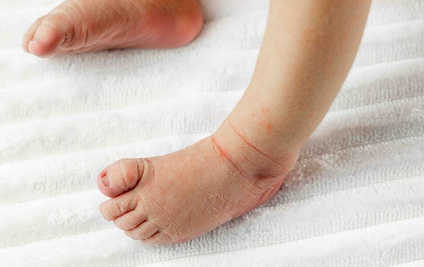 Omega-6 dan NUTRISI Lainnya Sebagai Solusi Kulit Kering Si Kecil