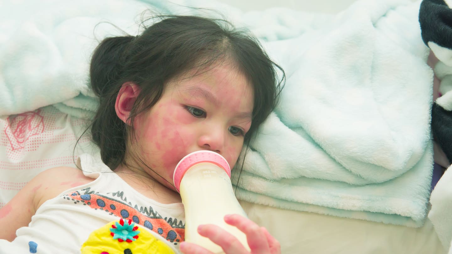 Tahapan Pemulihan Kulit Si Kecil Usai Kerumut Hilang