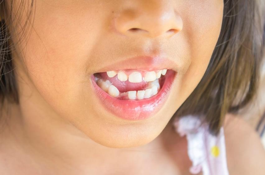 What Should You Do if Your Children’s Teeth Broken?