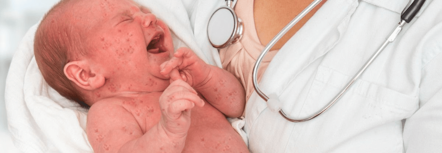 Penyebab Herpes pada Bayi Begitu Mudah Menular dan Gejalanya