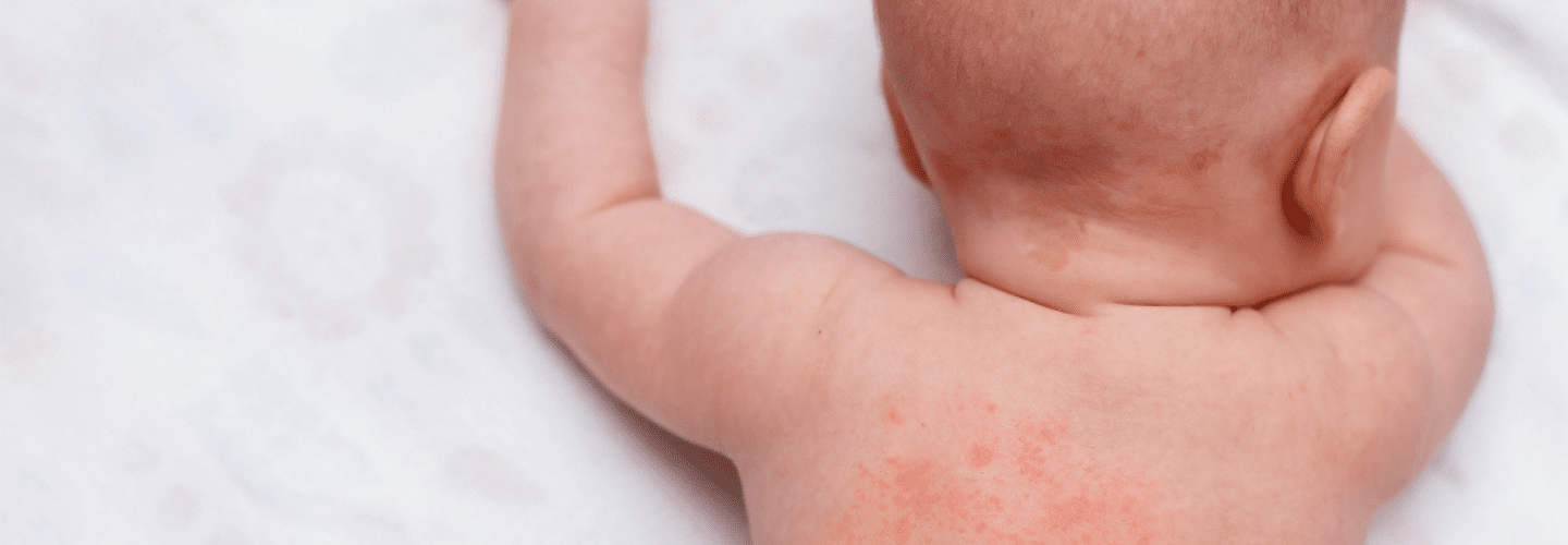 Mengenal Alergi Dingin pada Anak dan Cara Mengobatinya 
